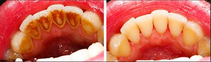 dental hygine