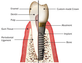 Dental Implant