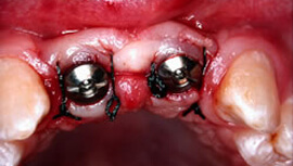 Exposure of implants